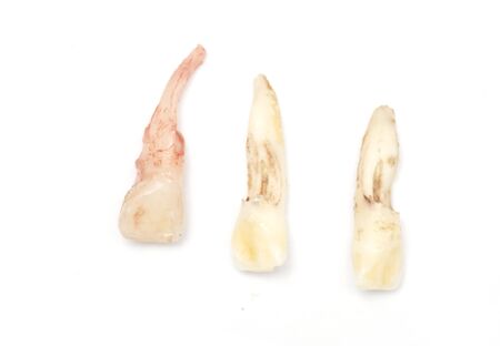 loosing of milk tooth, baby tooth or primary tooth, isolated on white background.の写真素材