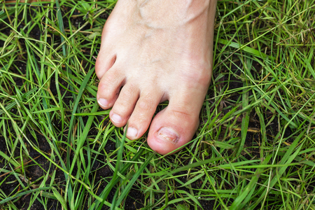 Bruised toe. Women's foot on the green grassの写真素材