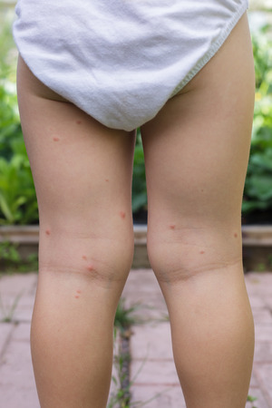 Bitten by mosquitoes legs of childの写真素材