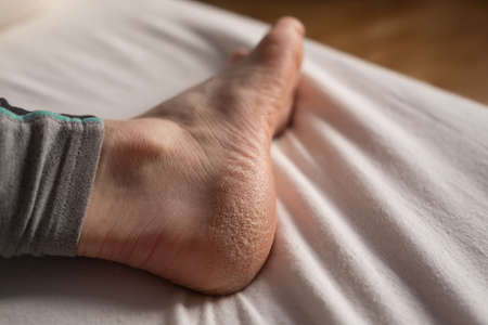 Skin disease in dry winter, dehydrated skin on the heels of female feetの写真素材
