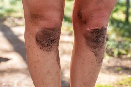 Dirty knees in an adult woman, close-up, in the camp, on a summer sunny day, on a blurred background.の写真素材