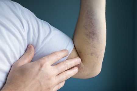 Large bruise on arm. Hand injury. Close-up.