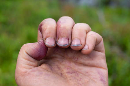 Dirty nails on fingers after gathering berriesの写真素材