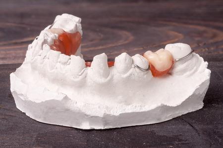 a plaster cast of teeth with removable partial denture on a dark wooden background.