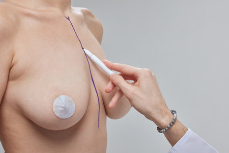 Breast Augmentation. Closeup Beautician Hands In Gloves Drawing Surgical Lines On Beautiful Woman Breast. Sexy Female Body With Black Marks On Breasts Before Plastic Surgery Operation. High Resolutionの写真素材