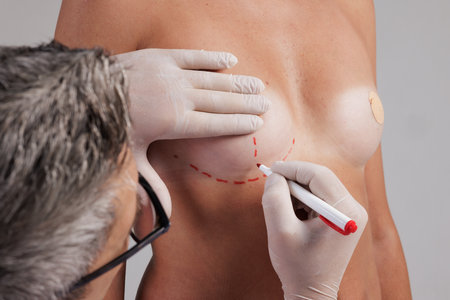 A plastic surgeon applies markings with a red marker before breast augmentation surgery, mammoplasty, concept beautiful breast shapeの写真素材