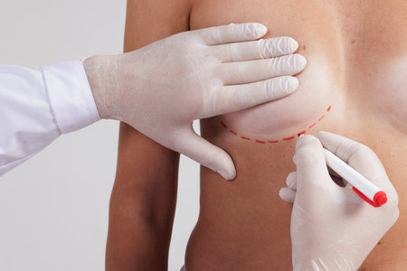 Plastic surgeon marking woman's breast on brown background, closeup, breast augmentation and shape correction concept.の写真素材