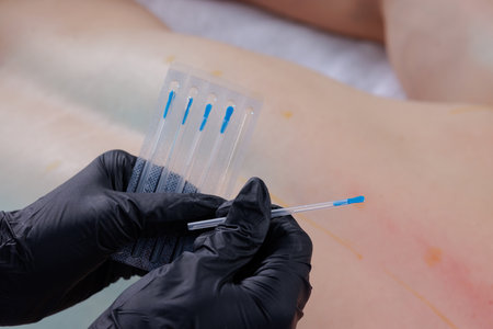 physician therapist holding thin needles close-up before myofascial trigger point therapy, dry needling and acupuncture sessionの写真素材