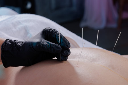 Close-up of a dry needling session where a practitioner inserts thin needles into a patient's back. Traditional Chinese medicine acupuncture to relieve pain and improve well-being.の写真素材