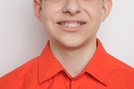 Teen boy smiling with colorful dental braces, close-up of teeth alignment and orthodontic treatment...