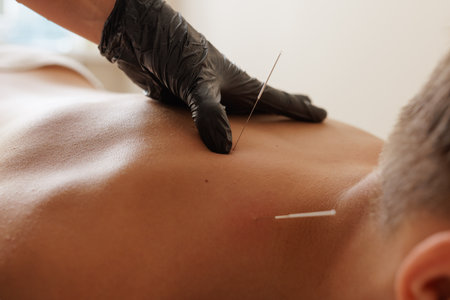 Close-up of dry needling session for muscle pain relief and rehabilitation, performed by a...