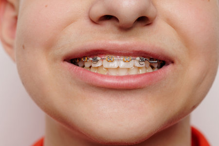 Close-up of teenagers smile with dental braces, showing orthodontic treatment for straight and...