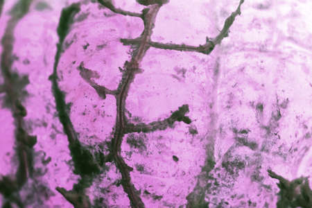 Human squamous cell carcinoma. Tissues affected by cancer cells under a microscope.