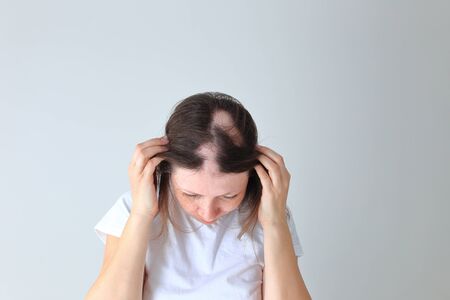 Real alopecia areata in a young girl. A bald head in a person.の写真素材