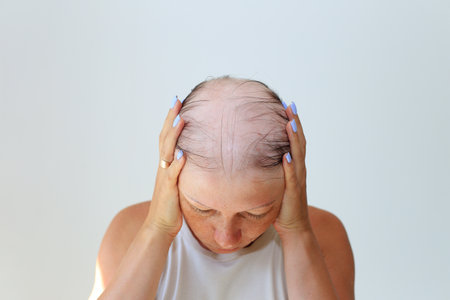 Hair loss in the form of alopecia areata. Bald head of a woman. Hair thinning after covid. Bald patches of total alopeciaの写真素材