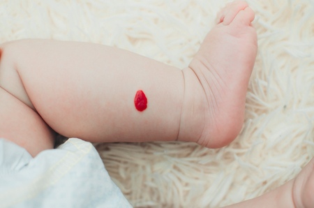 Hemangioma in a newborn baby girl on a legの写真素材