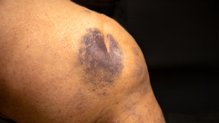 Bruised knee with dark purple and blue discoloration, close-up view, indicating injury or traumaの写真素材