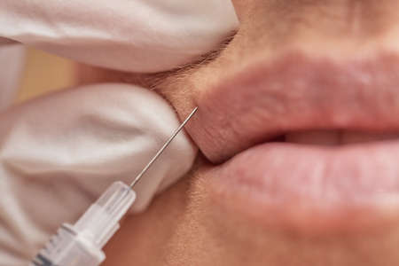 Close up shot of a woman making lip augmentation procedure by cosmetologistの写真素材