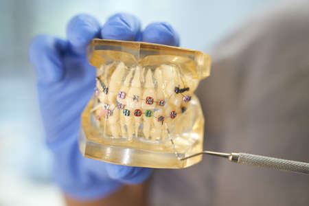 Dental specialist showing a set of braces on teeth setの写真素材