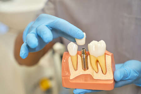 Plastic prop of teeth implant being shown by dentistの写真素材