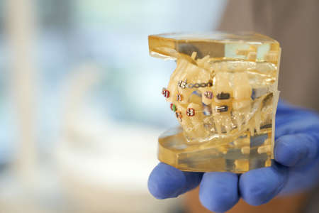 Fragment photo of set of teeth with braces system onの写真素材