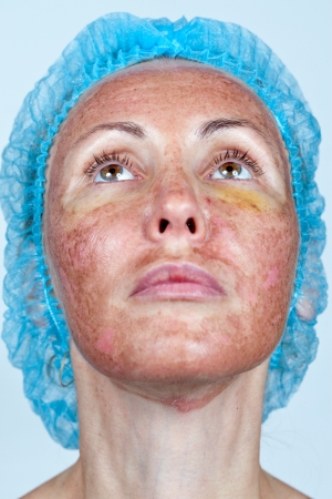Cosmetology. Chemical peeling. Boundary between the processed and healthy skin on a neck.の写真素材