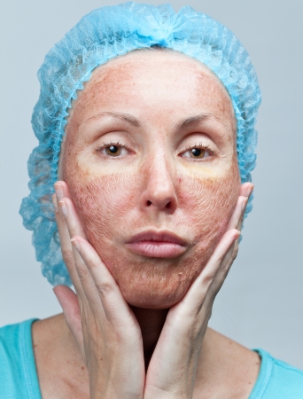 Cosmetology. Chemical peeling. "Parchment" skin before rejection.

の写真素材