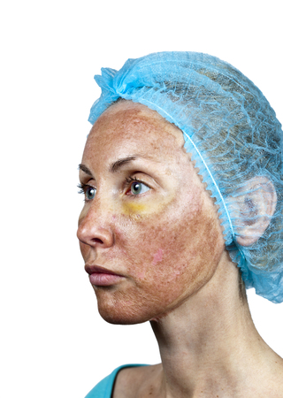 Cosmetology.Skin in the course of rejection after a deep chemical peeling. Boundary between the processed and healthy skin on a neck.の写真素材