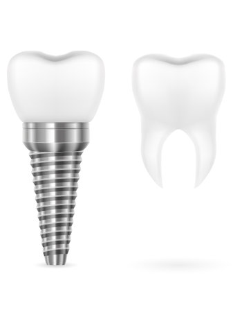 metal human tooth implant vector illustration isolated on white backgroundのイラスト素材