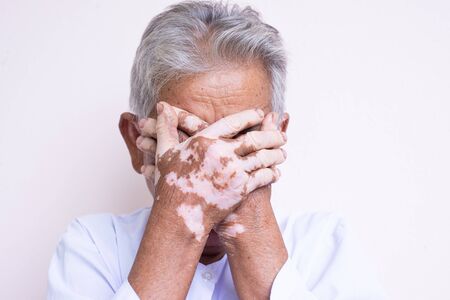 Vitiligo disease on old hand, some part of skin are tanned and the others are white by vitiligo symptoms, caucasian hand.の写真素材