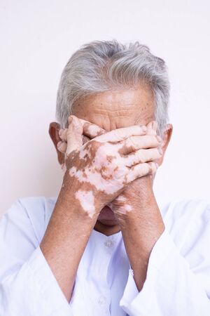 Vitiligo disease on old hand, some part of skin are tanned and the others are white by vitiligo symptoms, caucasian hand.の写真素材