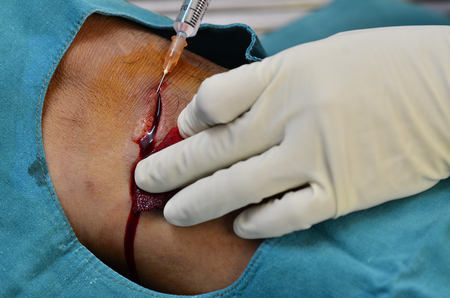 Doctor injecting anesthetic before suture stitch の写真素材