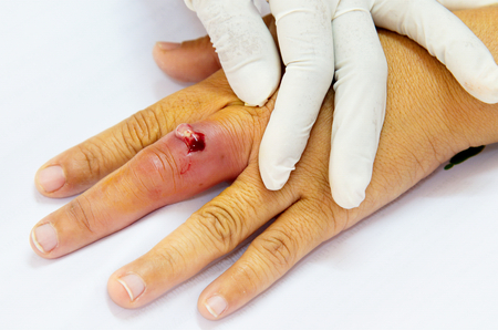 finger abscessedの写真素材