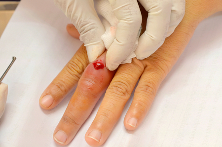 doctor was squeezing pus infected woundの写真素材