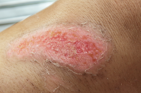 wound leg from motorcycle accident.
