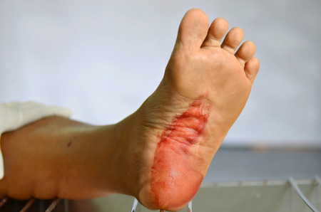 Dog bite and blood on foot.の写真素材
