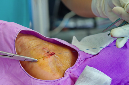 Suturing leg wound in the hospital.の写真素材