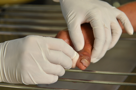 Infection accident thumb was cleaning to remove nail on dressing stool.の写真素材