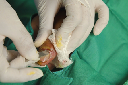 Infection accident thumb was suturing.の写真素材