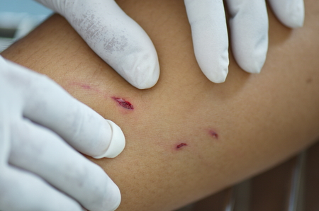 Dog bite wound pull three canine for dressing.の写真素材