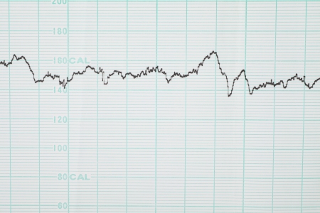 Fetal monitoring chartの写真素材