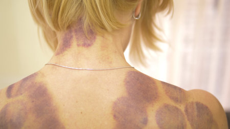 Round bruises. Traces on the back of a young woman after the procedure of vacuum cupping massage. Round bruisesの写真素材