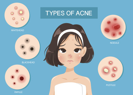 Types of acne occur on the face of the girl shot hair.のイラスト素材