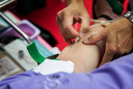 Nurse stabbing medical needles to donor arm. Blood Donor Making Donation In Hospital.