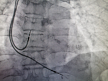DDDR pacemaker cable in x-ray image in cardiac catheterization laboratoryの写真素材