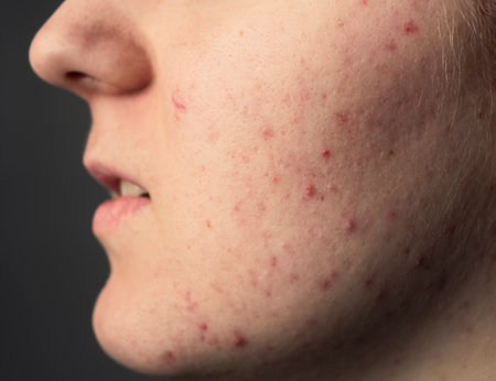 Pimple closeup. Acne and pimple. Skin care. Dermatology skincare. Puberty woman. Pimples problem.の写真素材