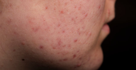 Skin texture background. Closeup acne pimple. Treatment for skin. Problem skincare. Pimples, acne, pores, scars. Natural skin. Skin care concept. Acne treatment. Pimples on face. Acne and pimple on face.の写真素材