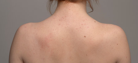 Skin texture. Skin care concept. Acne treatment. Acne pimple on back. Treatment for skin. Problem skincare. Pimples and Natural skin. Pimples on face. Acne and pimple on back. Pimples background.の写真素材