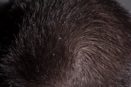 Dandruff hair. Messy hair. Hair with dandruff. Scalp problem, dandruff and dermatitis or eczema. Problem of dandruff. Hair disease seborrhea.の写真素材
