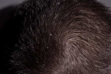 Shampoo. Dandruff hair. Messy hair. Hair with dandruff. Scalp problem, dandruff and dermatitis or eczema. Hair disease seborrhea. Problem of dandruff.の写真素材